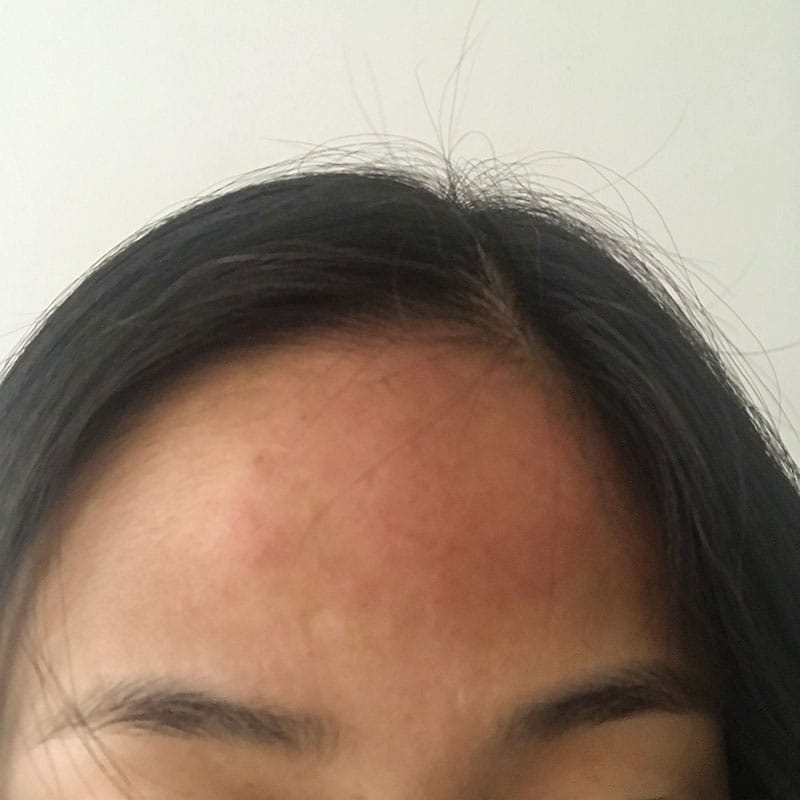 Swollen forehead from Lupus headaches