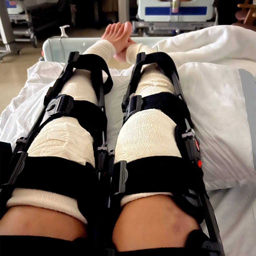 Leg Braces and Plaster Cast Post Knee Surgery