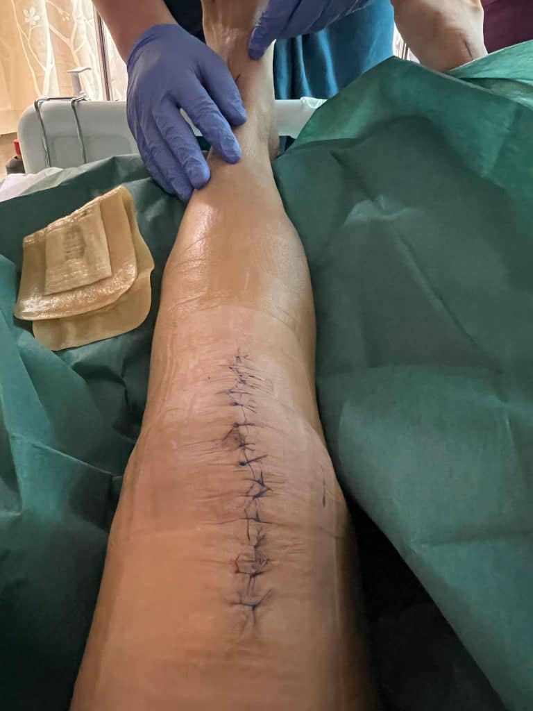 Cleaning Surgical Wound for Spontaneous Bilateral Patellar Tendon Rupture