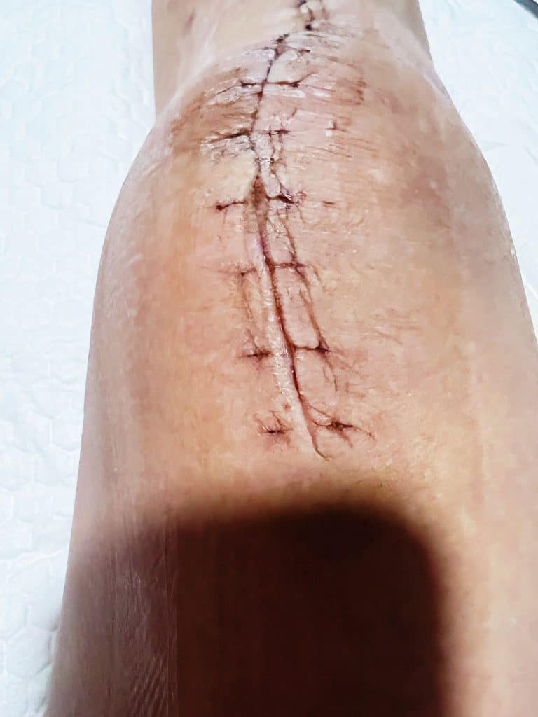 Patellar Tendon Rupture stitches and wounds