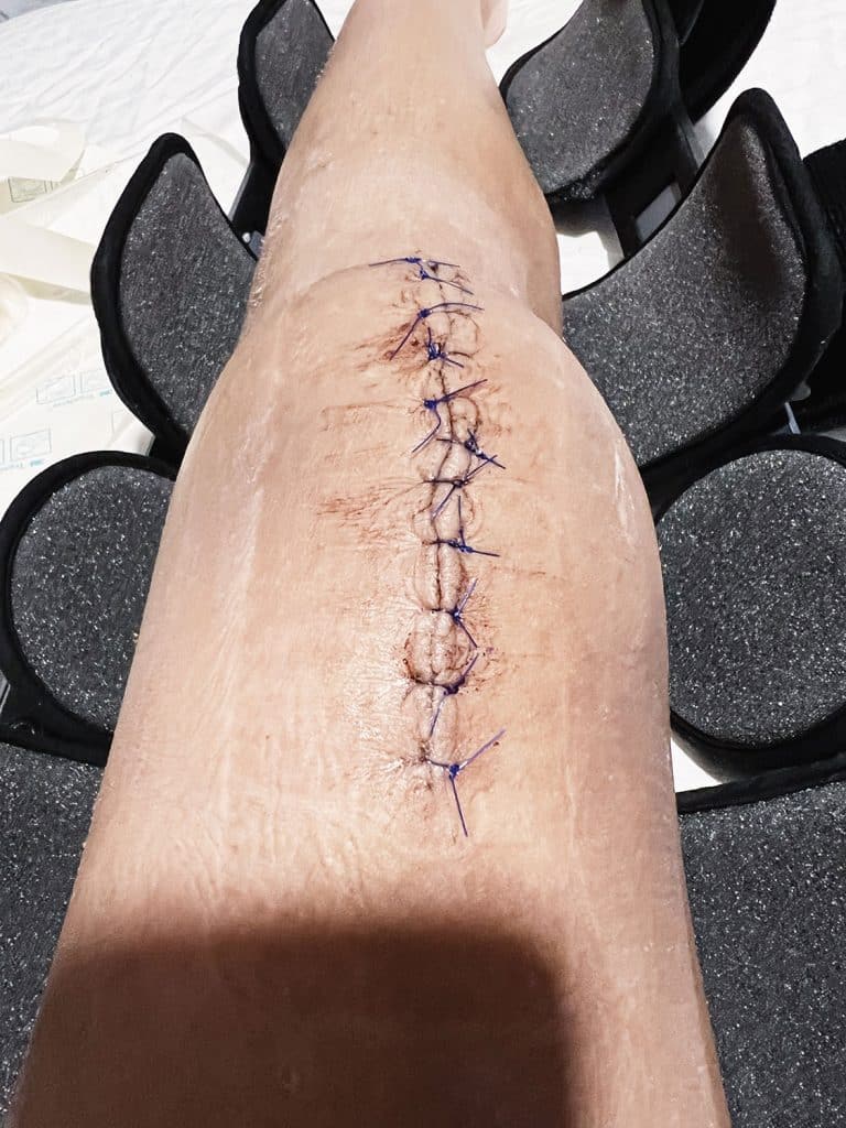 Stitches for Spontaneous Bilateral Patellar Tendon Rupture Knee  Surgery