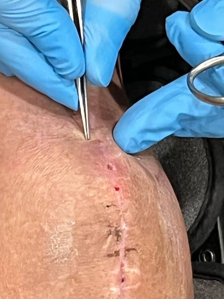 Removing stitches after knee surgery (dry flaky skin)