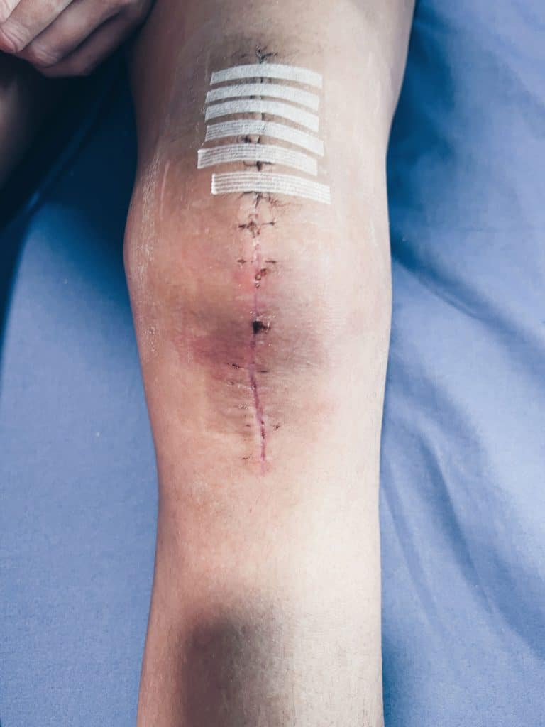 Steri-strips skin closures used after major knee surgery